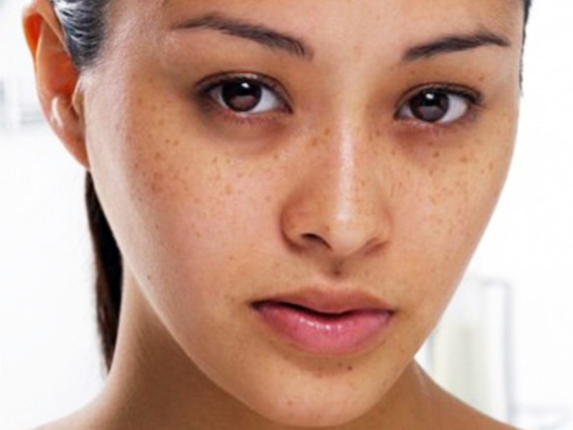 how to get rid of dark circles permanently for Girls